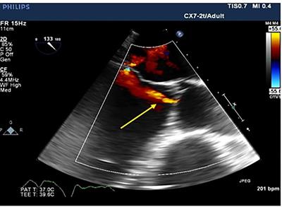 Frontiers Case Report A Novel Surgical Technique For Rapid Valve In